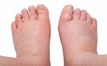 붓는 발, 발목, 다리: 하체 부종 치료법 6가지