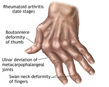 손 관절염에 좋은 자연 요법 7가지