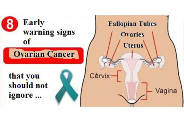 무시해선 안되는 난소암의 초기 징후 8가지