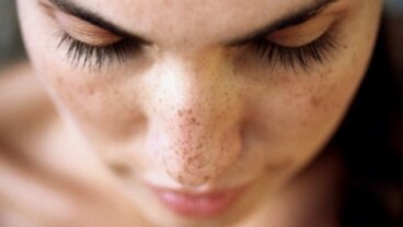 얼굴 잡티를 제거하는 6가지 천연 치료제