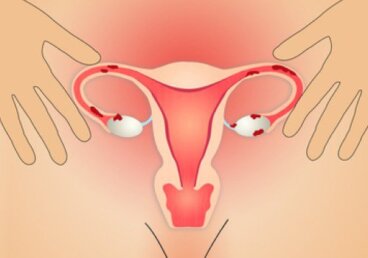 자궁내막증을 위한 5가지 자연요법