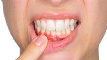 치아 낭종은 무엇일까?